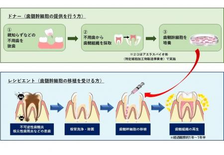 世界初となる他人の歯髄幹細胞を用いた「歯髄再生治療