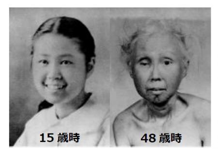 世界初！早老症ウェルナー症候群患者さんを対象とする