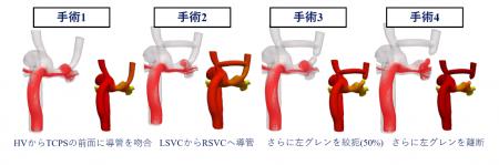 株式会社Cardio Flow Designの血流解析ソフト「iTSurg 株式会社Cardio Flow Designの血流解析ソフト「iTSurg