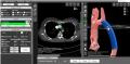 株式会社Cardio Flow Designの血流解析ソフト「iTSurg 株式会社Cardio Flow Designの血流解析ソフト「iTSurg