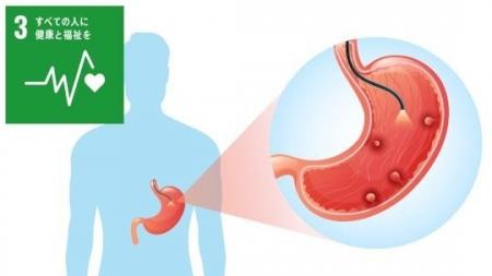 GAPPSにおける胃癌発生に関わる遺伝子変異の解明 GAPPSにおける胃癌発生に関わる遺伝子変異の解明