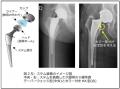 人工股関節全置換術後の骨折予防に新展開?-カラー(襟 人工股関節全置換術後の骨折予防に新展開?-カラー(襟