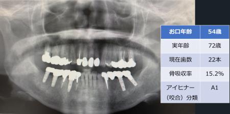 歯科エックス線画像を用いた「お口年齢AI」の開発につ 歯科エックス線画像を用いた「お口年齢AI」の開発につ