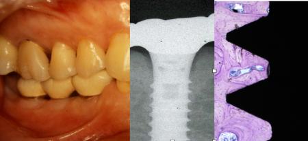 We Got It アカデミー、歯科衛生士のためのインプラン We Got It アカデミー、歯科衛生士のためのインプラン