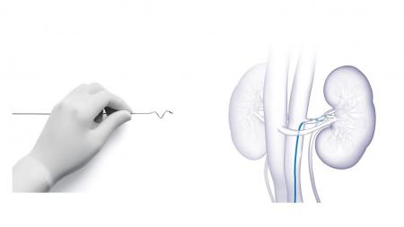 日本メドトロニック 高血圧治療を行うデバイス「Symp 日本メドトロニック 高血圧治療を行うデバイス「Symp