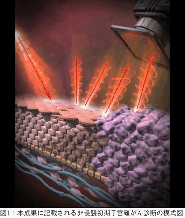 深部異形成を非侵襲に捉える円偏光散乱(CiPLS)イutf-8 深部異形成を非侵襲に捉える円偏光散乱(CiPLS)イutf-8