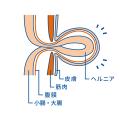6月1日は、自然治癒のない身近な疾患「鼠径ヘルutf-8 6月1日は、自然治癒のない身近な疾患「鼠径ヘルutf-8