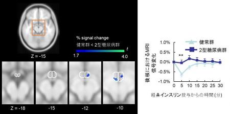 2型糖尿病における「脳のインスリン抵抗性」は視床下 2型糖尿病における「脳のインスリン抵抗性」は視床下
