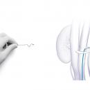 日本メドトロニック　高血圧治療を行うデバイス「Symp